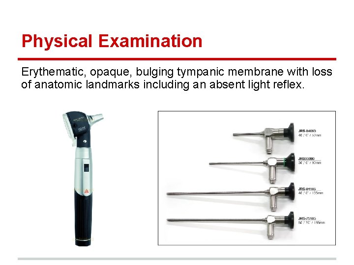 Physical Examination Erythematic, opaque, bulging tympanic membrane with loss of anatomic landmarks including an