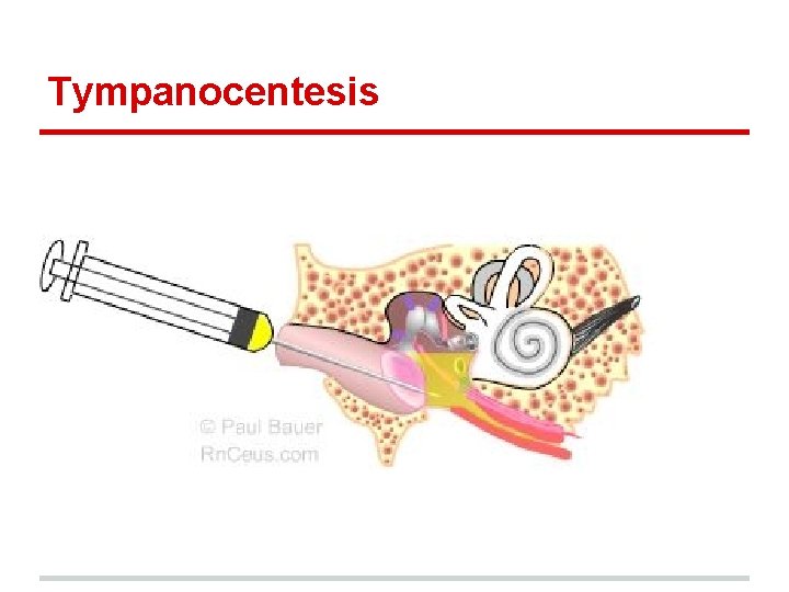 Tympanocentesis 