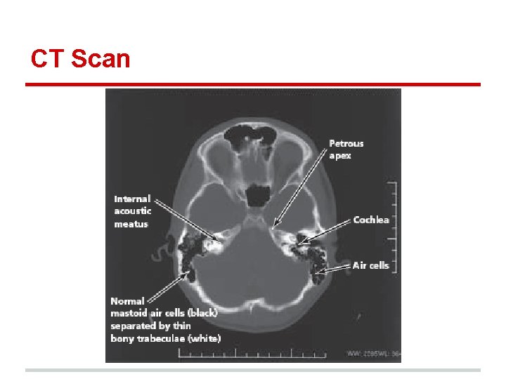 CT Scan 