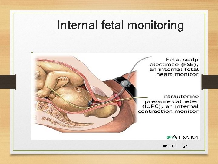 Internal fetal monitoring • 10/24/2021 24 