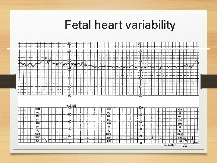 Fetal heart variability 10/24/2021 25 