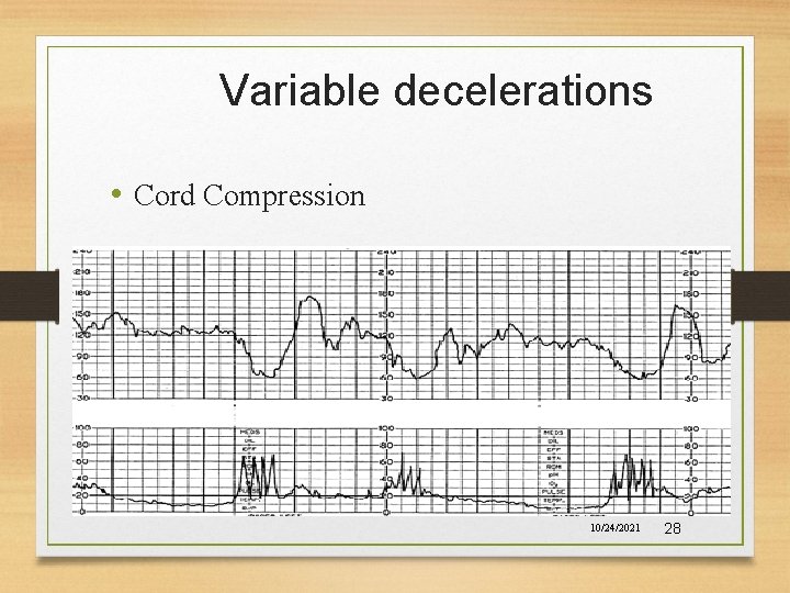 Variable decelerations • Cord Compression 10/24/2021 28 