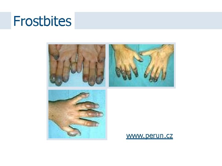 Frostbites www. perun. cz 