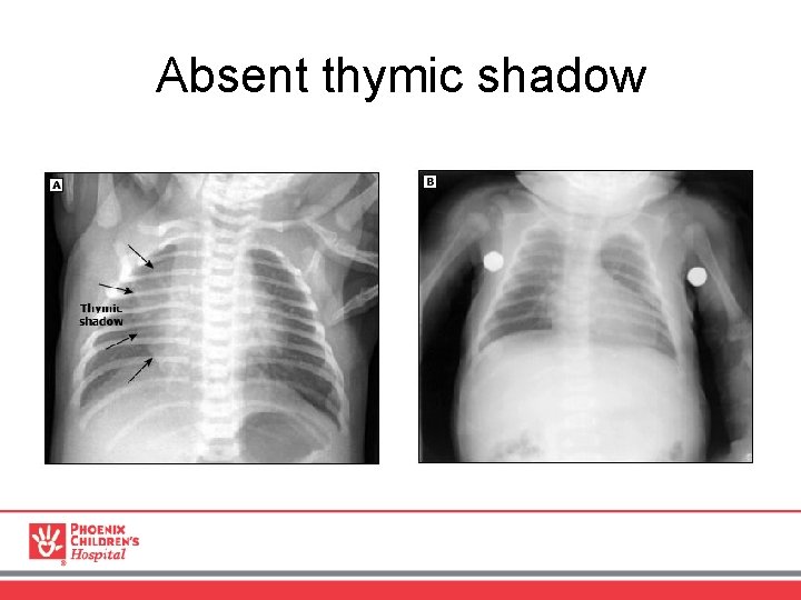 Absent thymic shadow 