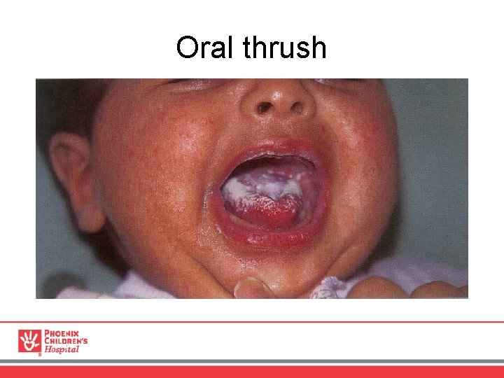 Oral thrush 