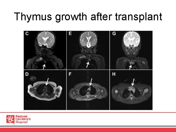 Thymus growth after transplant 