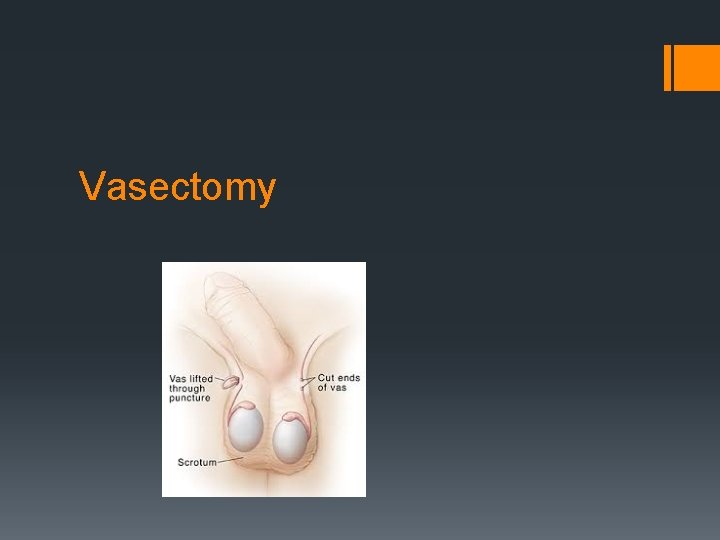 Vasectomy 