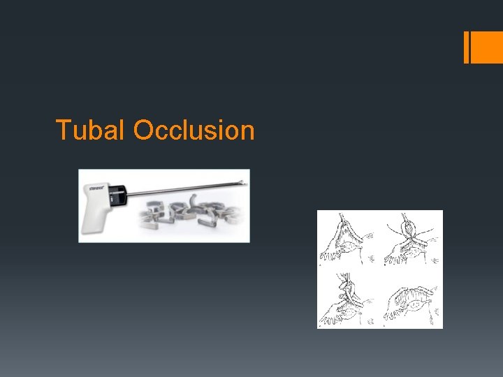 Tubal Occlusion 