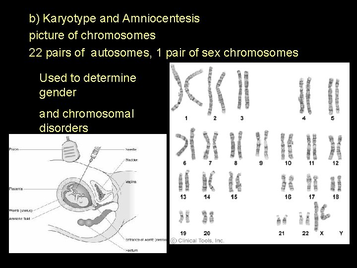 b) Karyotype and Amniocentesis picture of chromosomes 22 pairs of autosomes, 1 pair of
