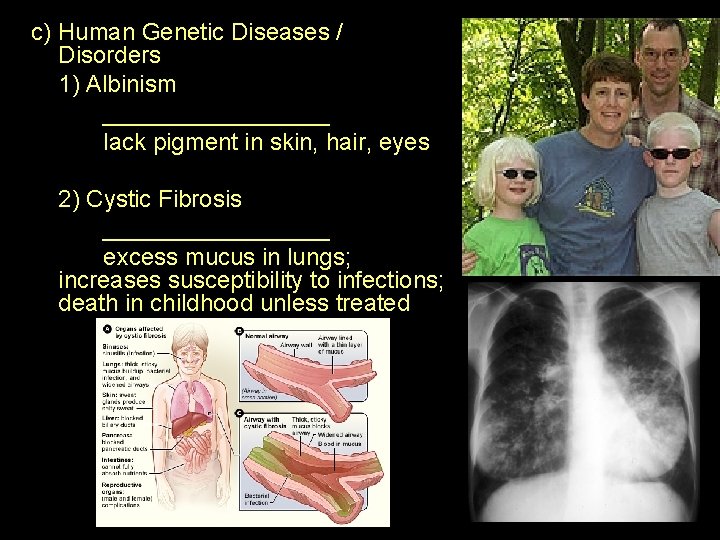 c) Human Genetic Diseases / Disorders 1) Albinism _________ lack pigment in skin, hair,