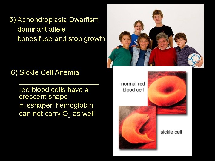 5) Achondroplasia Dwarfism dominant allele bones fuse and stop growth 6) Sickle Cell Anemia