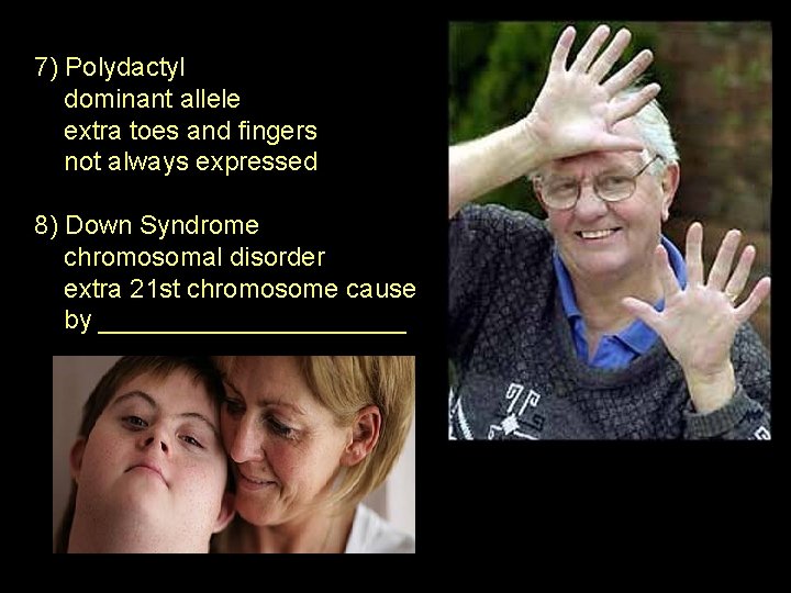 7) Polydactyl dominant allele extra toes and fingers not always expressed 8) Down Syndrome