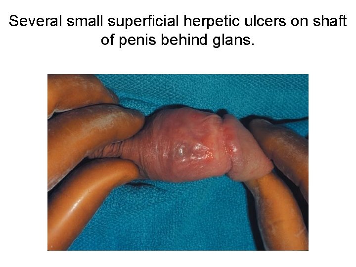 Several small superficial herpetic ulcers on shaft of penis behind glans. 