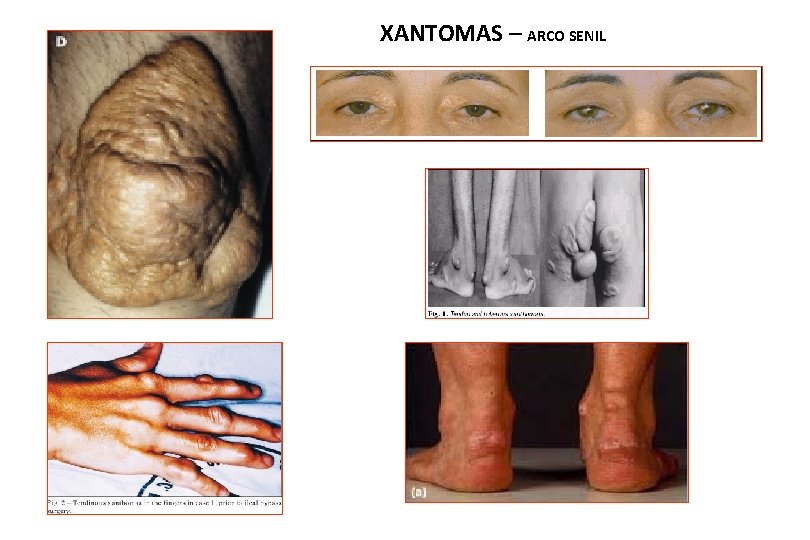 XANTOMAS – ARCO SENIL 