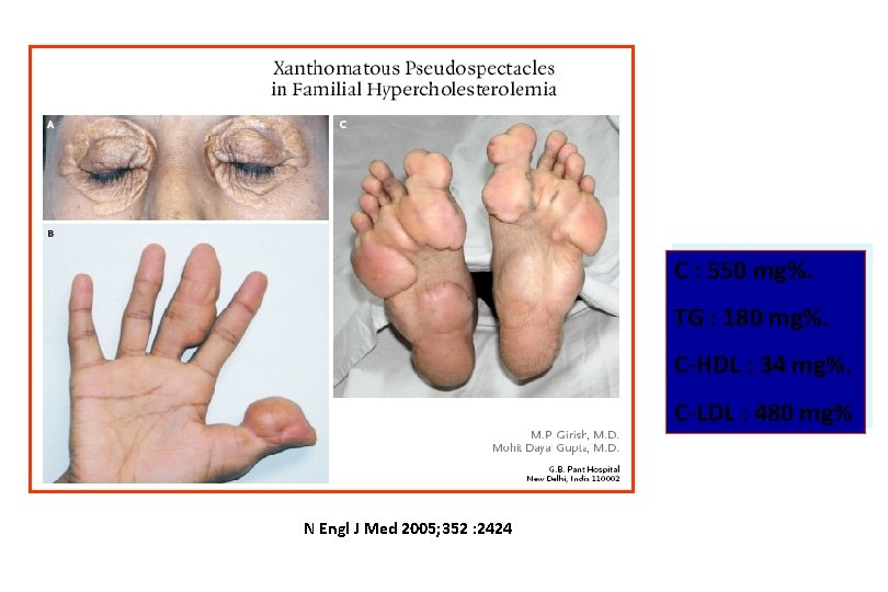 C : 550 mg%. TG : 180 mg%. C-HDL : 34 mg%. C-LDL :