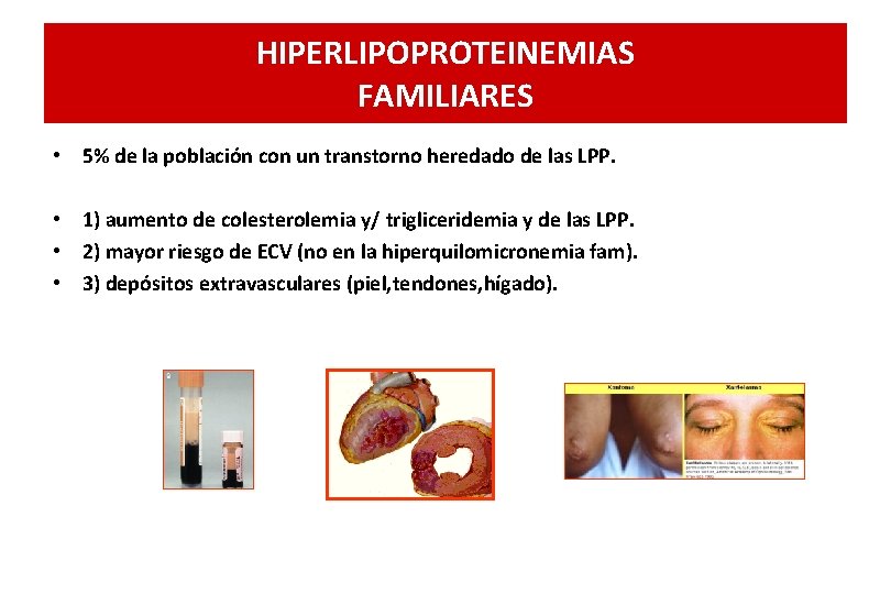 HIPERLIPOPROTEINEMIAS FAMILIARES • 5% de la población con un transtorno heredado de las LPP.