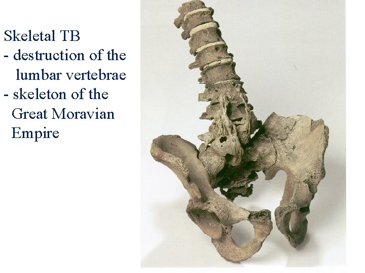 Skeletal TB - destruction of the lumbar vertebrae - skeleton of the Great Moravian