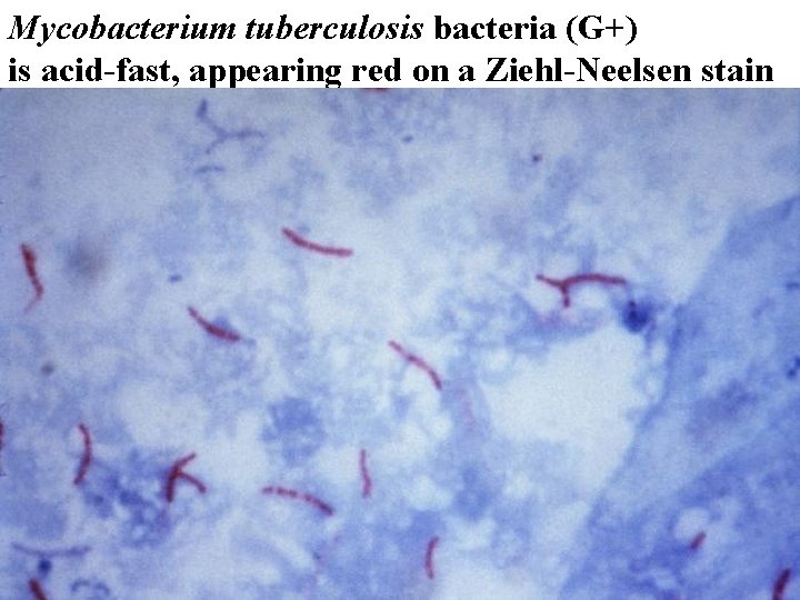 Mycobacterium tuberculosis bacteria (G+) is acid-fast, appearing red on a Ziehl-Neelsen stain 
