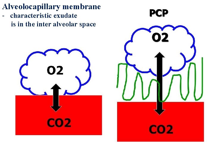 Alveolocapillary membrane - characteristic exudate is in the inter alveolar space 