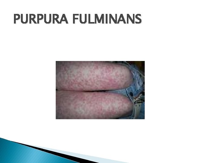 PURPURA FULMINANS 