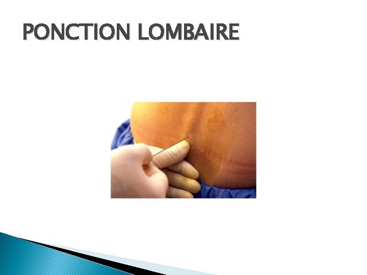 PONCTION LOMBAIRE 