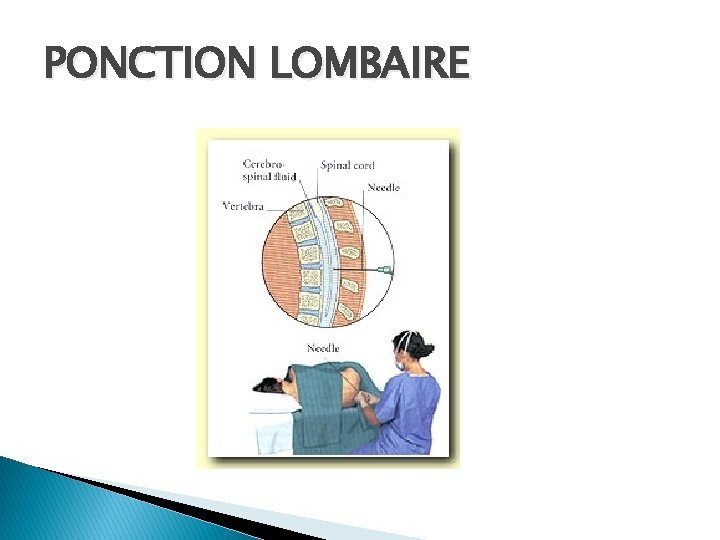 PONCTION LOMBAIRE 