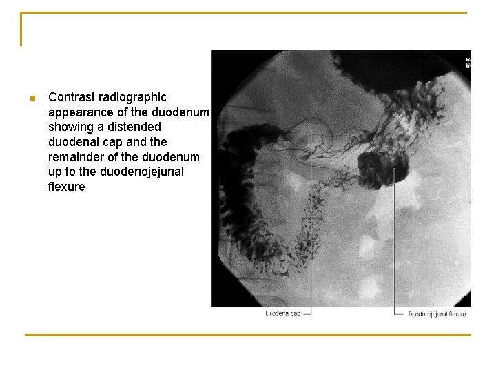 n Contrast radiographic appearance of the duodenum showing a distended duodenal cap and the
