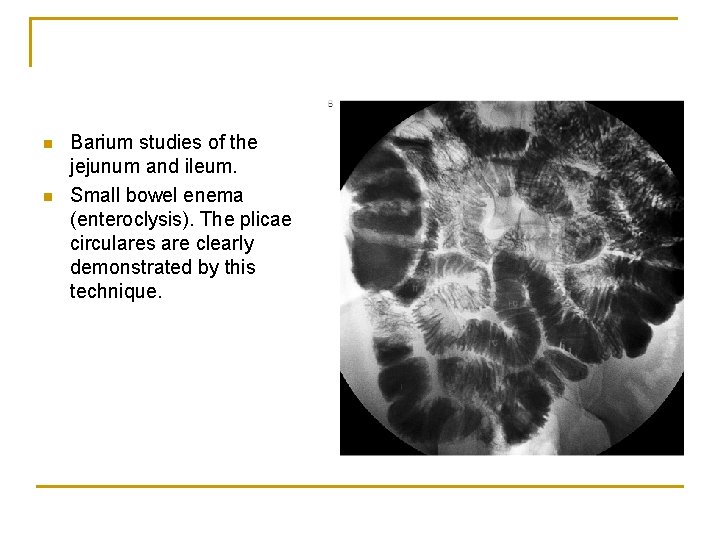 n n Barium studies of the jejunum and ileum. Small bowel enema (enteroclysis). The