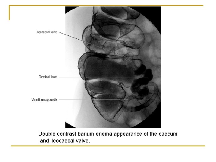 Double contrast barium enema appearance of the caecum and ileocaecal valve. 