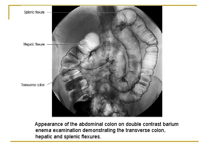 Appearance of the abdominal colon on double contrast barium enema examination demonstrating the transverse