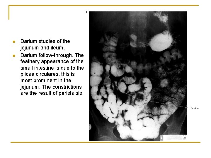 n n Barium studies of the jejunum and ileum. Barium follow-through. The feathery appearance