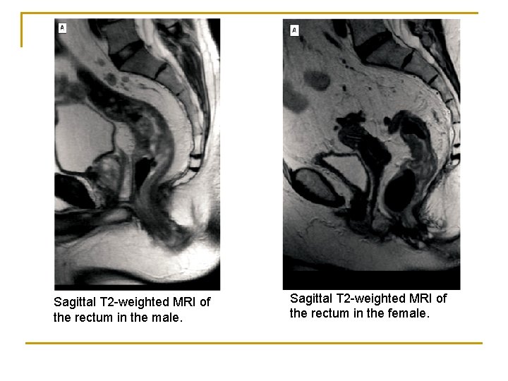 Sagittal T 2 -weighted MRI of the rectum in the male. Sagittal T 2