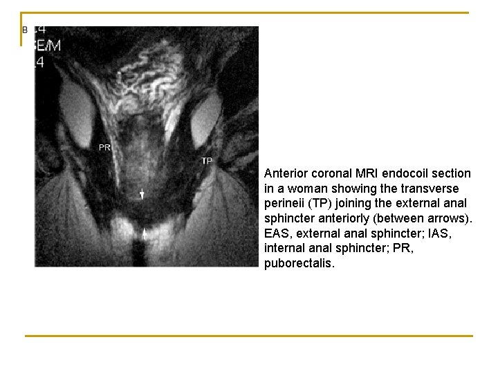 Anterior coronal MRI endocoil section in a woman showing the transverse perineii (TP) joining