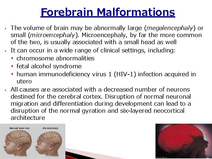 Forebrain Malformations • • • The volume of brain may be abnormally large (megalencephaly)
