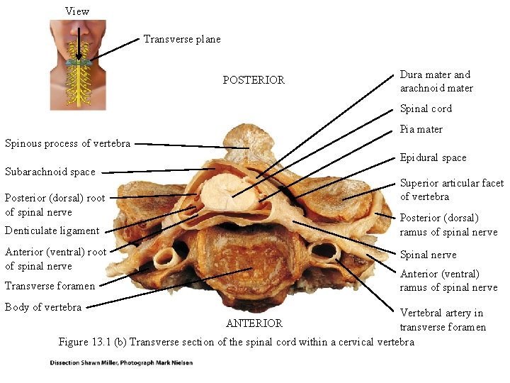 View Transverse plane POSTERIOR Dura mater and arachnoid mater Spinal cord Pia mater Spinous