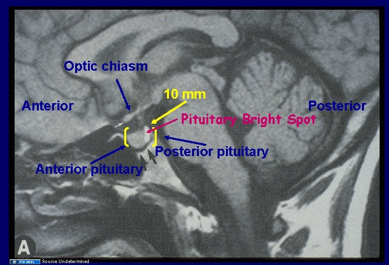 Optic chiasm Anterior 10 mm Posterior Pituitary Bright Spot Posterior pituitary Anterior pituitary Source