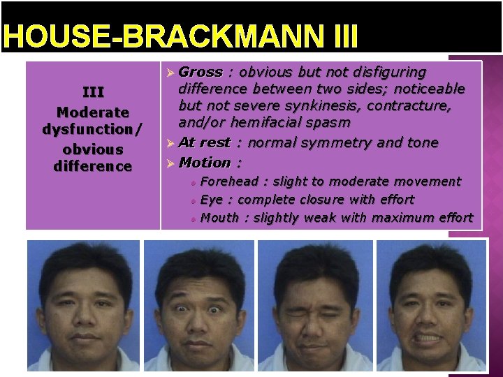 HOUSE-BRACKMANN III Ø Gross III Moderate dysfunction/ obvious difference : obvious but not disfiguring