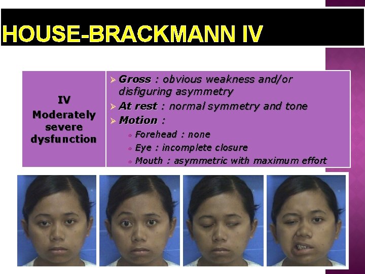 HOUSE-BRACKMANN IV Ø Gross IV Moderately severe dysfunction : obvious weakness and/or disfiguring asymmetry