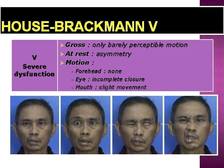 HOUSE-BRACKMANN V Ø Gross V Severe dysfunction : only barely perceptible motion Ø At