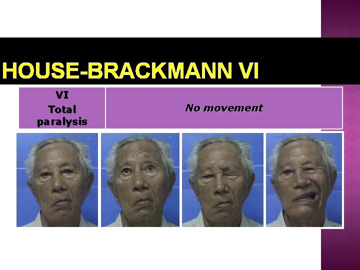 HOUSE-BRACKMANN VI VI Total paralysis No movement 
