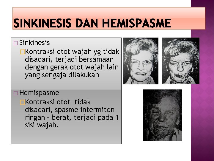 � Sinkinesis �Kontraksi otot wajah yg tidak disadari, terjadi bersamaan dengan gerak otot wajah