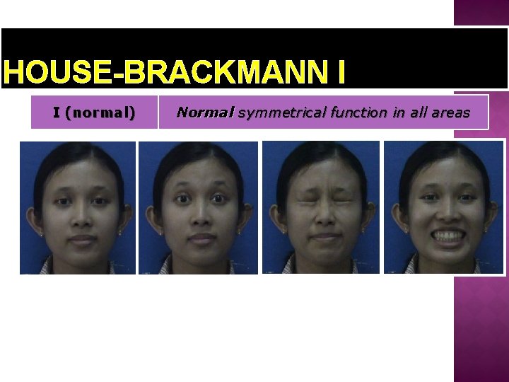 HOUSE-BRACKMANN I I (normal) Normal symmetrical function in all areas 