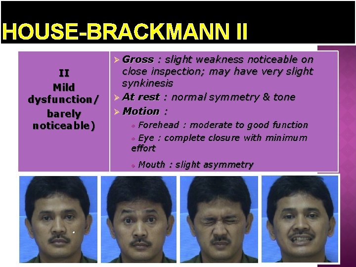 HOUSE-BRACKMANN II Ø Gross II Mild dysfunction/ barely noticeable) : slight weakness noticeable on