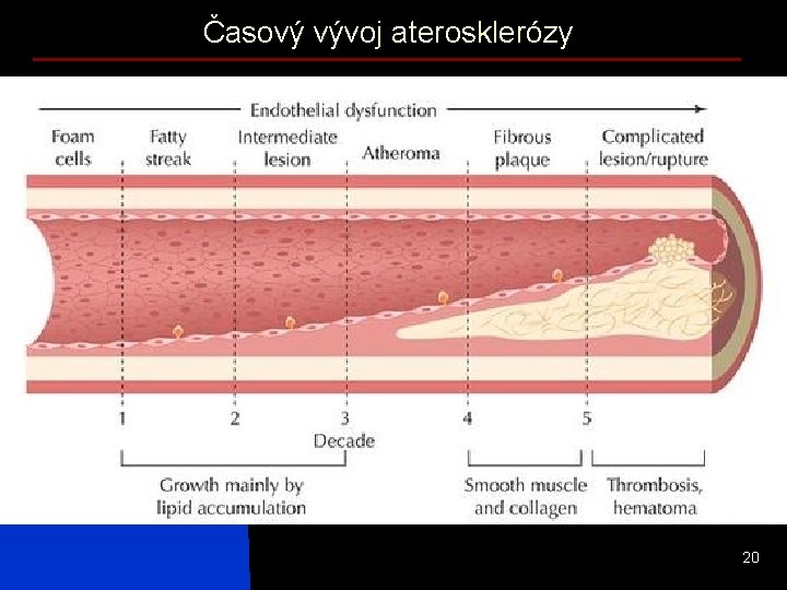 Časový vývoj aterosklerózy 20 