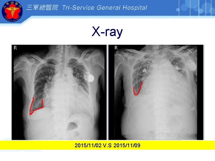 X-ray 2015/11/02 V. S 2015/11/09 