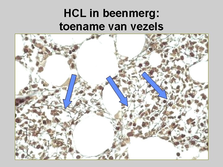 HCL in beenmerg: toename van vezels 