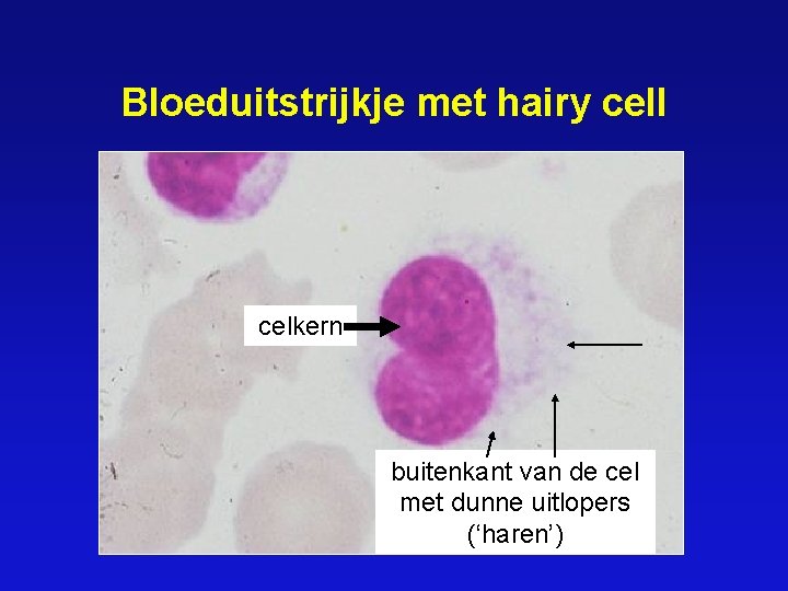 Bloeduitstrijkje met hairy cell celkern buitenkant van de cel met dunne uitlopers (‘haren’) 