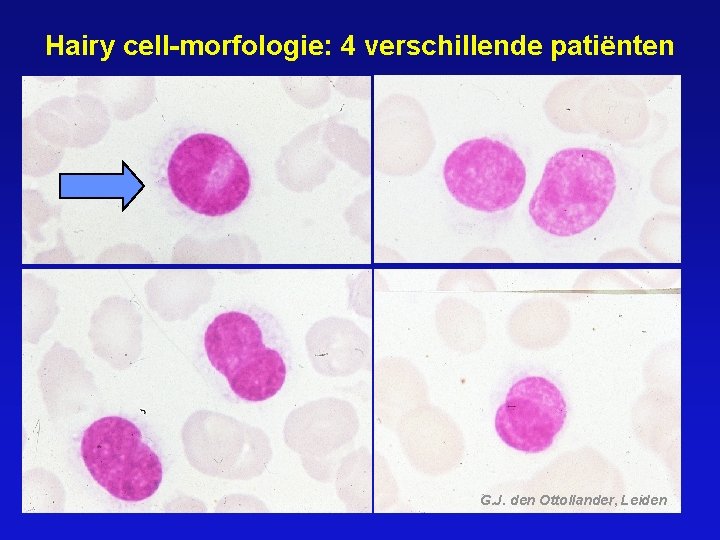 Hairy cell-morfologie: 4 verschillende patiënten G. J. den Ottollander, Leiden 