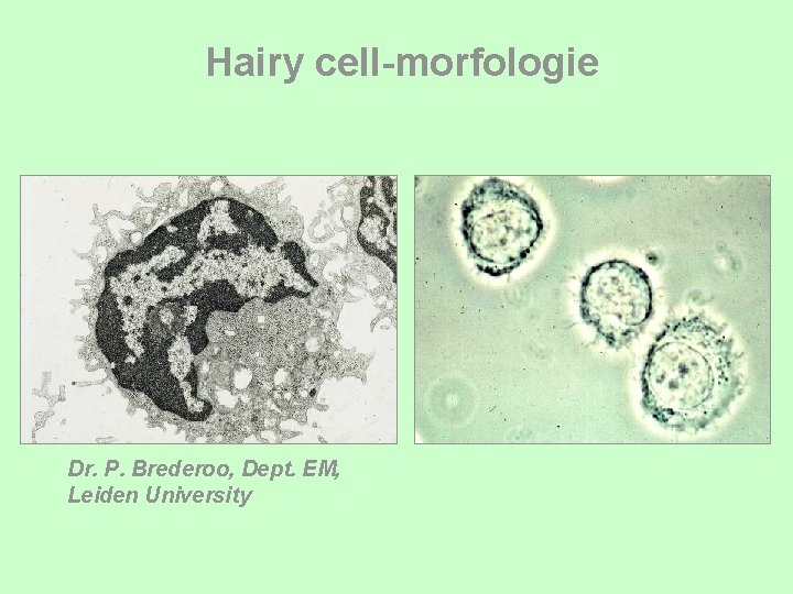 Hairy cell-morfologie Dr. P. Brederoo, Dept. EM, Leiden University 