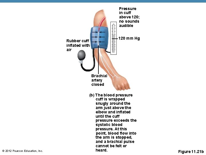 Pressure in cuff above 120; no sounds audible 120 mm Hg Rubber cuff inflated